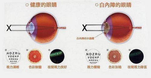 只有老年人才会得白内障吗